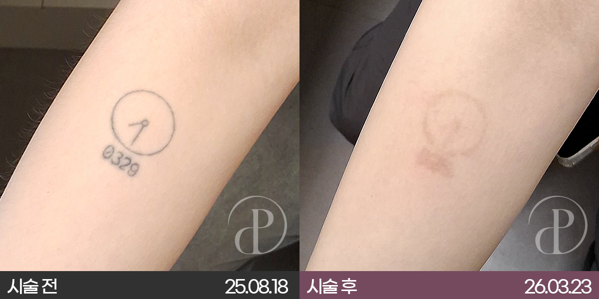 대전 문신제거, 한 번에 지워질까요? 횟수와 통증 총정리