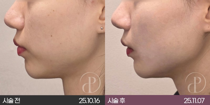 세르프 리프팅 샷 수가 많으면 효과도 좋을까요?