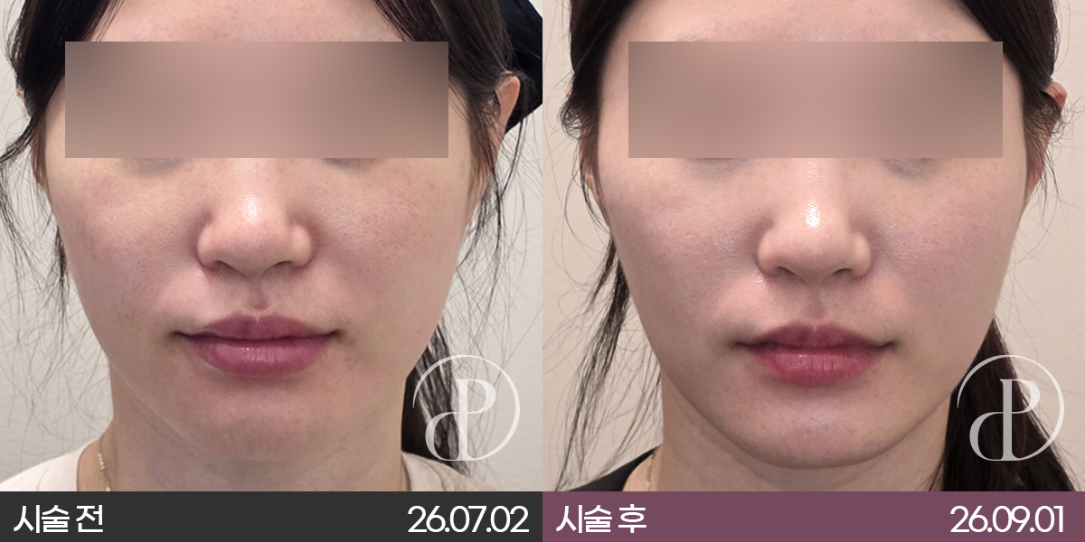 세르프 리프팅 샷 수가 많으면 효과도 좋을까요?